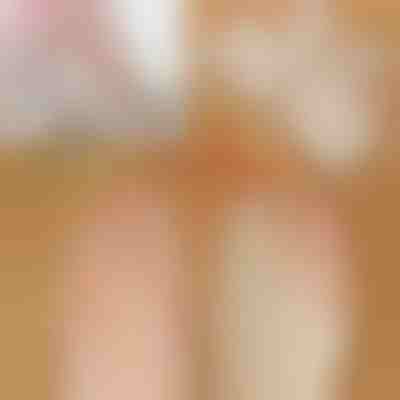 Corrector ortopédico de juanetes para los dedos del pie FIXEDFEET, 1 par (izquierdo + derecho)